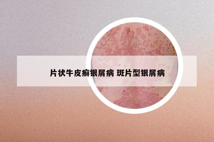 片状牛皮癣银屑病 斑片型银屑病