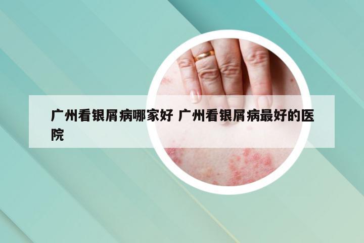 广州看银屑病哪家好 广州看银屑病最好的医院