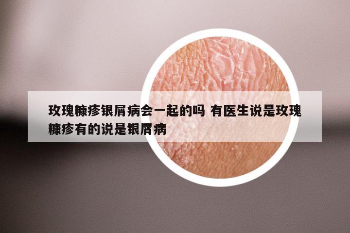 玫瑰糠疹银屑病会一起的吗 有医生说是玫瑰糠疹有的说是银屑病