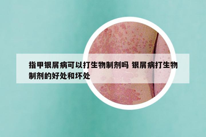 指甲银屑病可以打生物制剂吗 银屑病打生物制剂的好处和坏处