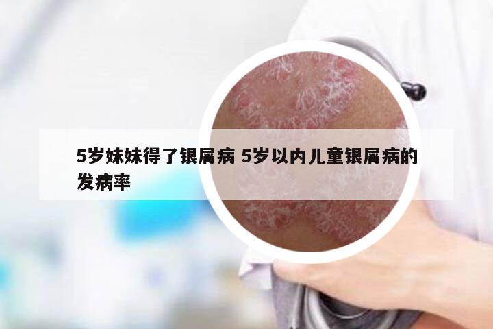 5岁妹妹得了银屑病 5岁以内儿童银屑病的发病率