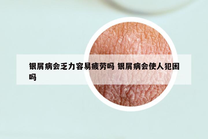 银屑病会乏力容易疲劳吗 银屑病会使人犯困吗