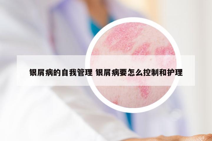 银屑病的自我管理 银屑病要怎么控制和护理
