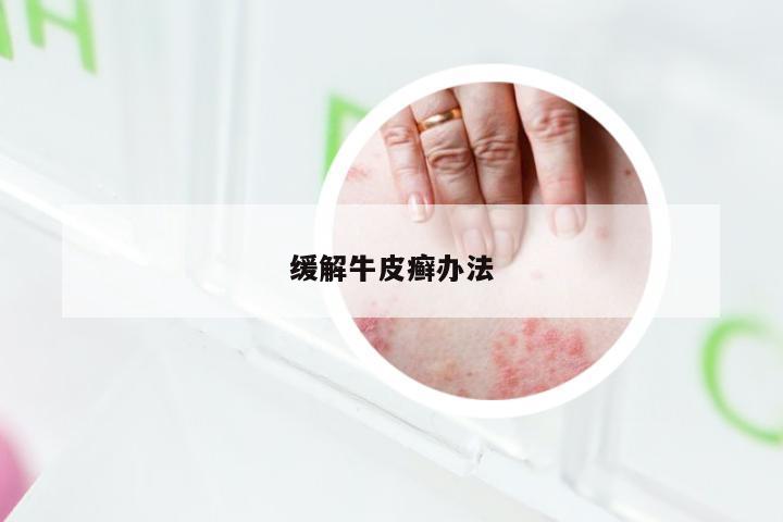 缓解牛皮癣办法