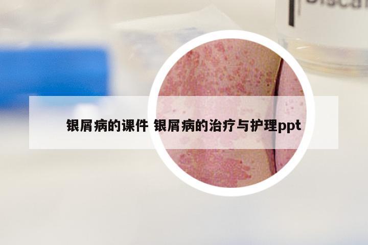 银屑病的课件 银屑病的治疗与护理ppt
