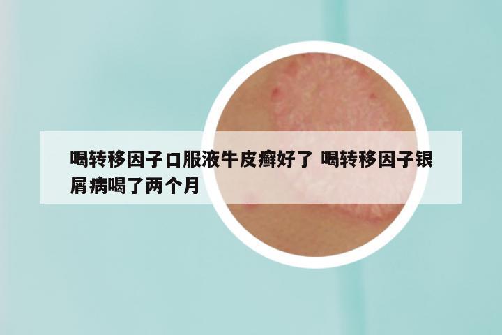 喝转移因子口服液牛皮癣好了 喝转移因子银屑病喝了两个月