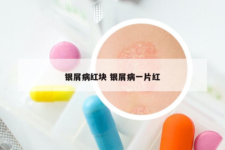 银屑病红块 银屑病一片红