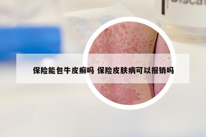 保险能包牛皮癣吗 保险皮肤病可以报销吗