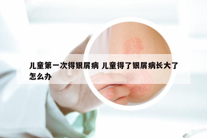 儿童第一次得银屑病 儿童得了银屑病长大了怎么办