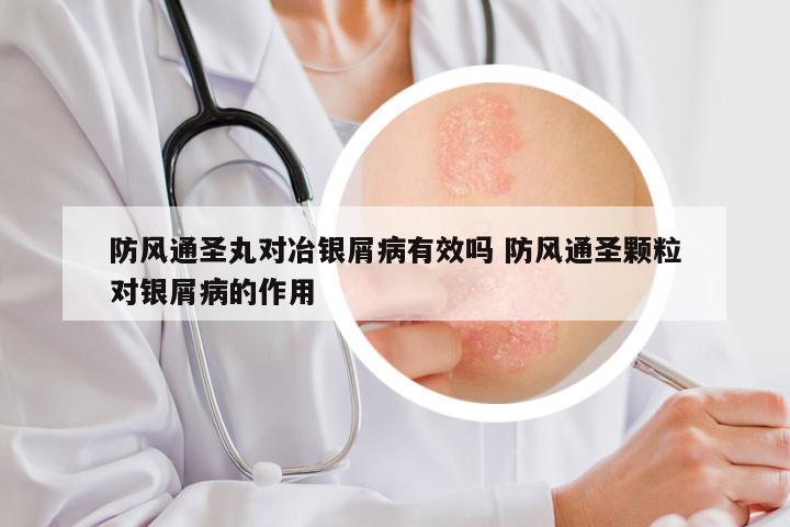 防风通圣丸对冶银屑病有效吗 防风通圣颗粒对银屑病的作用