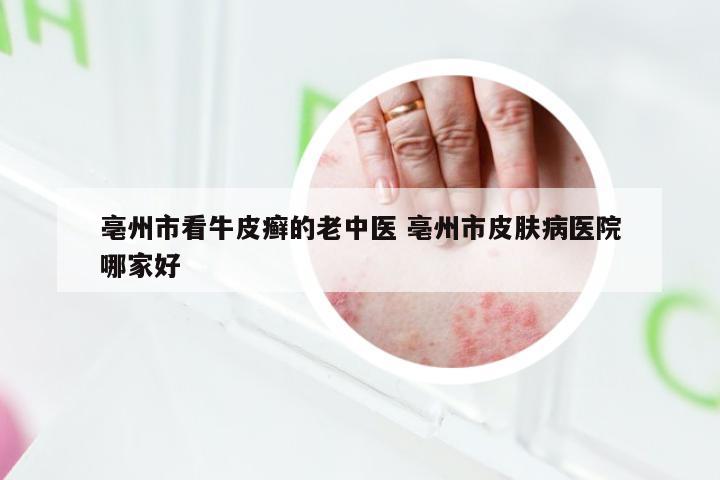 亳州市看牛皮癣的老中医 亳州市皮肤病医院哪家好