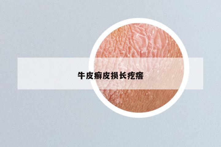牛皮癣皮损长疙瘩