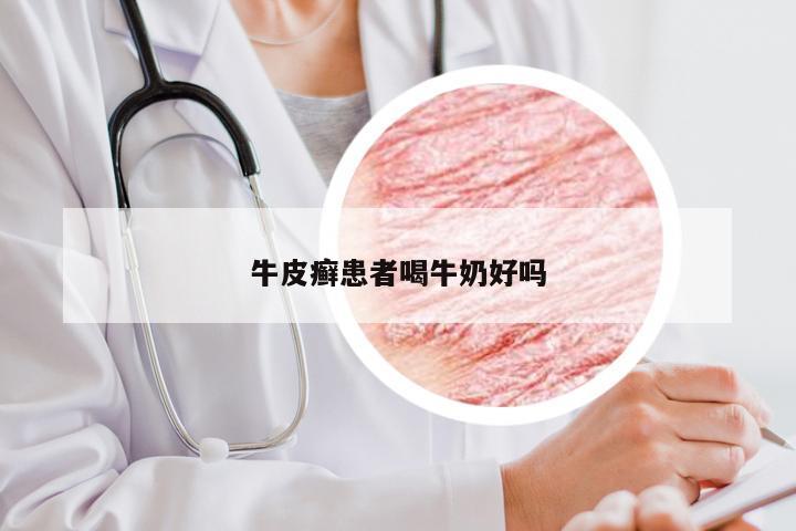 牛皮癣患者喝牛奶好吗