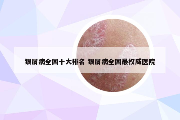 银屑病全国十大排名 银屑病全国最权威医院