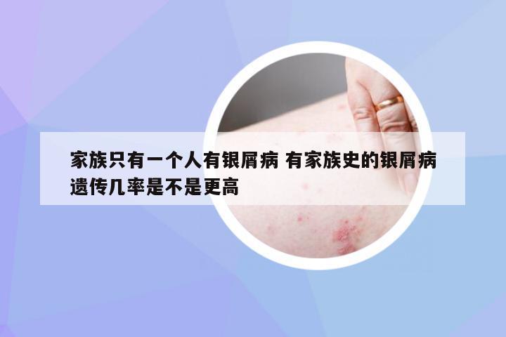 家族只有一个人有银屑病 有家族史的银屑病遗传几率是不是更高