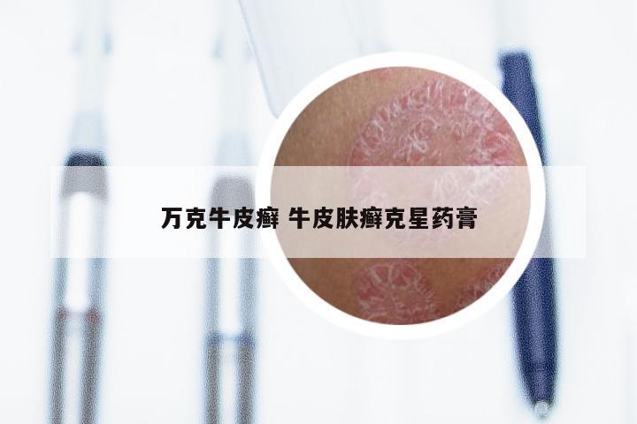 万克牛皮癣 牛皮肤癣克星药膏