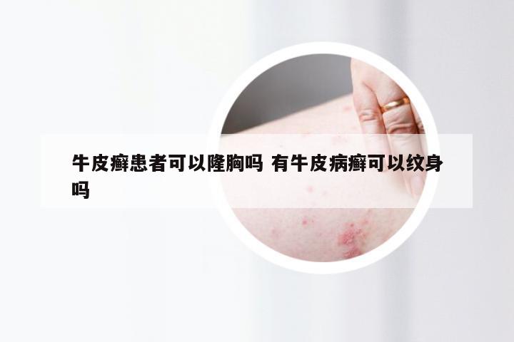 牛皮癣患者可以隆胸吗 有牛皮病癣可以纹身吗