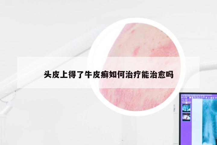 头皮上得了牛皮癣如何治疗能治愈吗