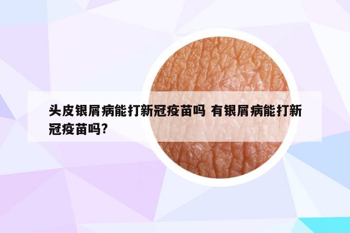 头皮银屑病能打新冠疫苗吗 有银屑病能打新冠疫苗吗?