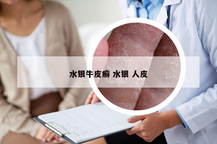 水银牛皮癣 水银 人皮