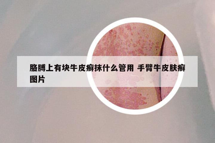 胳膊上有块牛皮癣抹什么管用 手臂牛皮肤癣图片