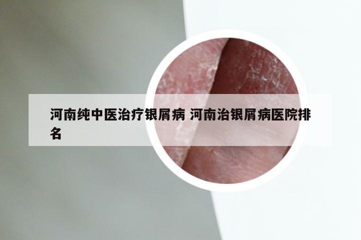河南纯中医治疗银屑病 河南治银屑病医院排名