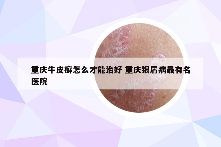 重庆牛皮癣怎么才能治好 重庆银屑病最有名医院