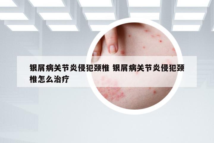 银屑病关节炎侵犯颈椎 银屑病关节炎侵犯颈椎怎么治疗