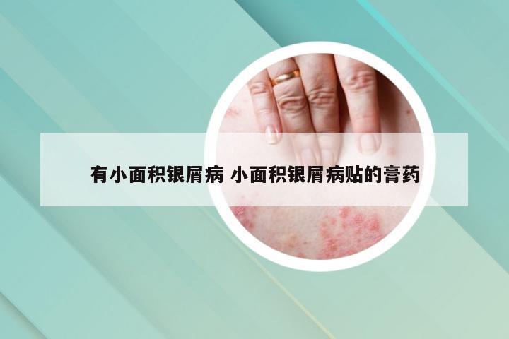 有小面积银屑病 小面积银屑病贴的膏药