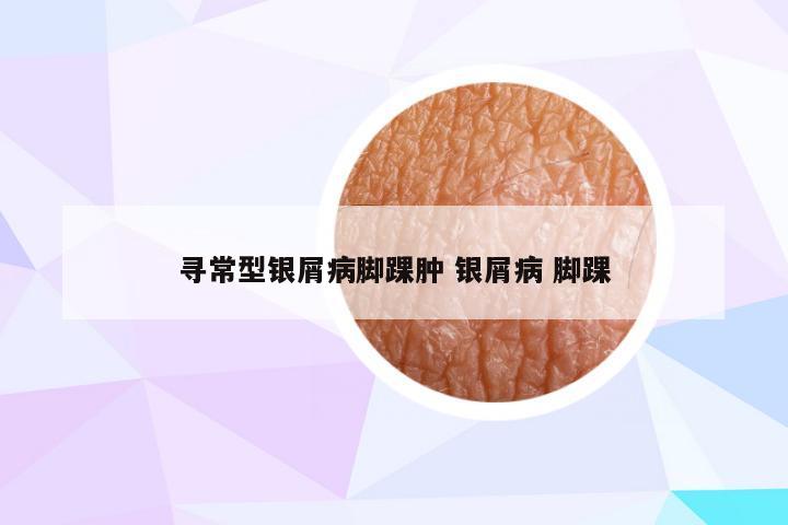 寻常型银屑病脚踝肿 银屑病 脚踝