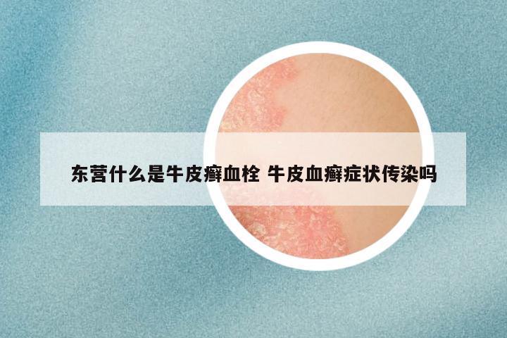 东营什么是牛皮癣血栓 牛皮血癣症状传染吗