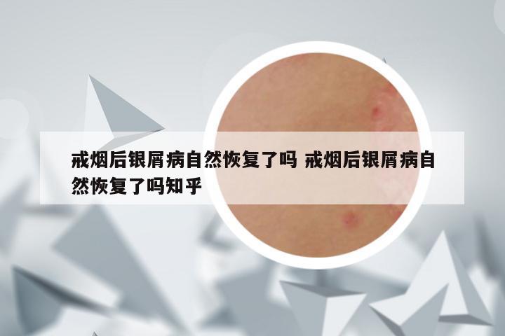 戒烟后银屑病自然恢复了吗 戒烟后银屑病自然恢复了吗知乎