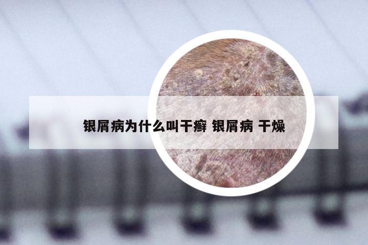 银屑病为什么叫干癣 银屑病 干燥