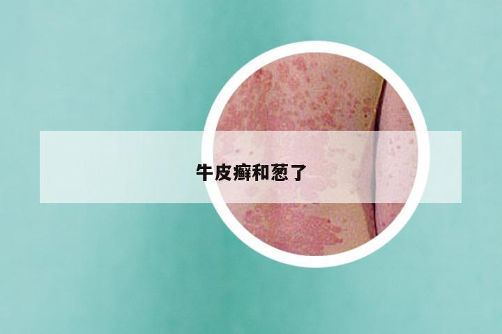 牛皮癣和葱了