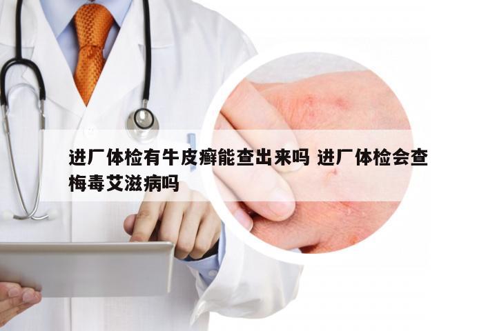 进厂体检有牛皮癣能查出来吗 进厂体检会查梅毒艾滋病吗