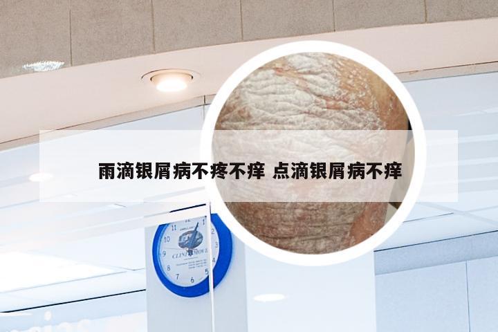 雨滴银屑病不疼不痒 点滴银屑病不痒