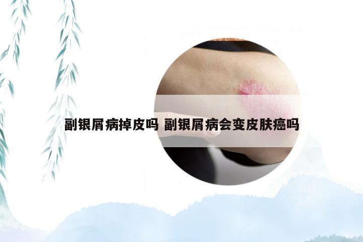 副银屑病掉皮吗 副银屑病会变皮肤癌吗