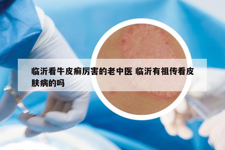 临沂看牛皮癣厉害的老中医 临沂有祖传看皮肤病的吗