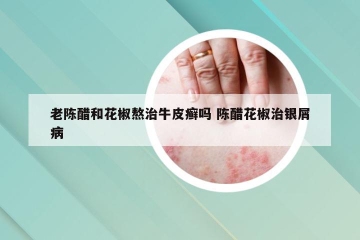 老陈醋和花椒熬治牛皮癣吗 陈醋花椒治银屑病