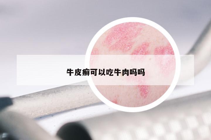 牛皮癣可以吃牛肉吗吗