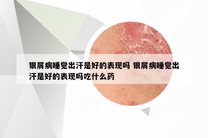 银屑病睡觉出汗是好的表现吗 银屑病睡觉出汗是好的表现吗吃什么药