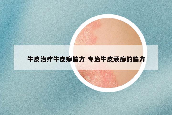 牛皮治疗牛皮癣偏方 专治牛皮顽癣的偏方