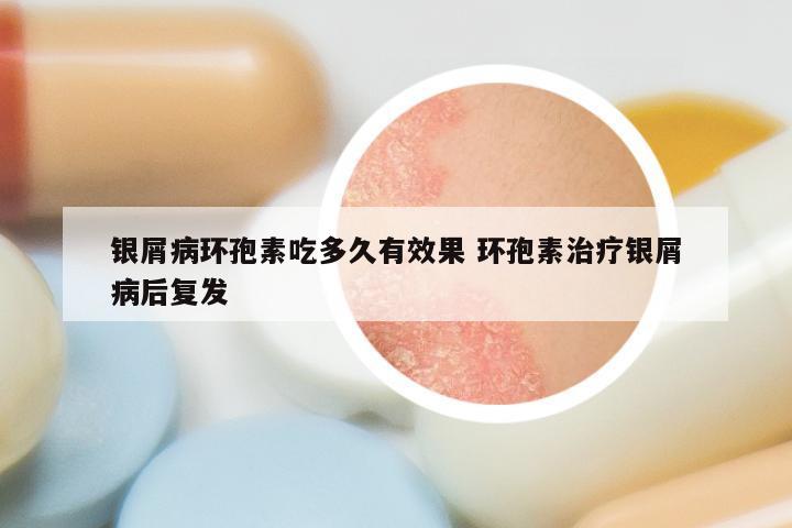 银屑病环孢素吃多久有效果 环孢素治疗银屑病后复发