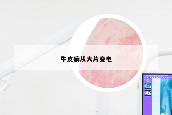 牛皮癣从大片变电