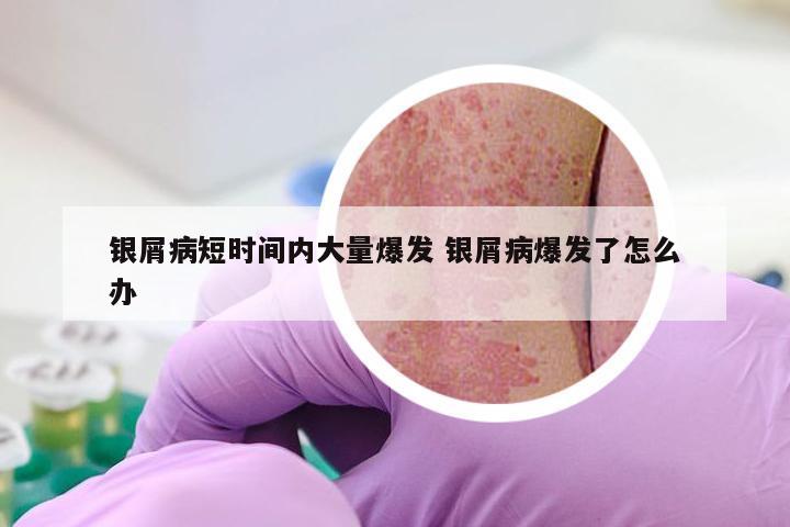 银屑病短时间内大量爆发 银屑病爆发了怎么办