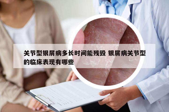 关节型银屑病多长时间能残毁 银屑病关节型的临床表现有哪些