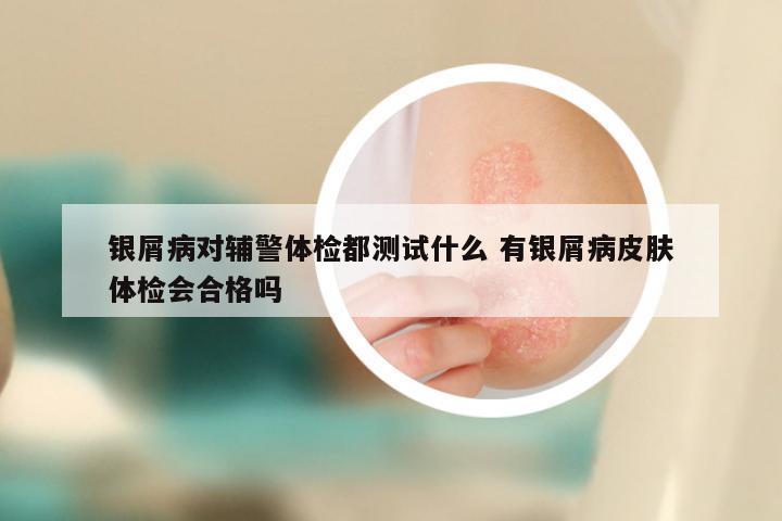 银屑病对辅警体检都测试什么 有银屑病皮肤体检会合格吗