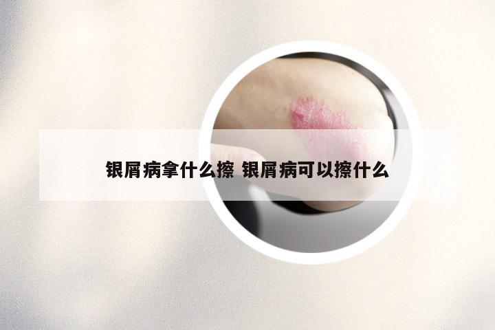 银屑病拿什么擦 银屑病可以擦什么