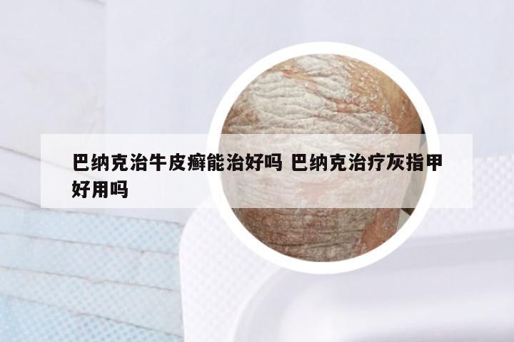 巴纳克治牛皮癣能治好吗 巴纳克治疗灰指甲好用吗