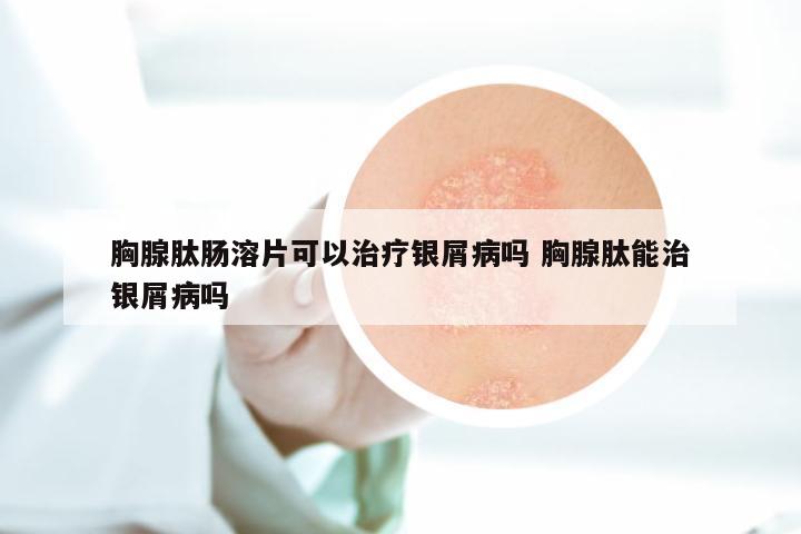 胸腺肽肠溶片可以治疗银屑病吗 胸腺肽能治银屑病吗
